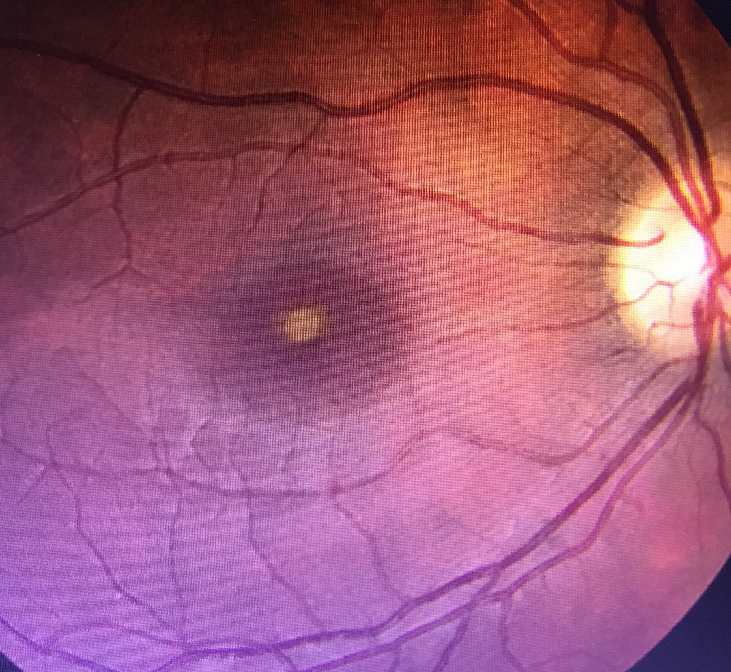 Man whose vision was damaged during '83 eclipse warns of dangers | ksdk.com